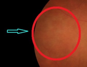 Fig. 7. Nell'immagine è possibile vedere un'area di trazione vitreo-retinica in periferia (zona cerchiata in rosso).