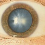 Cirugía de cataratas: Control de la inflamación e infección ocular